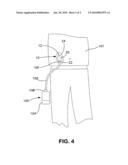 Ostomy appliance apparatus diagram and image