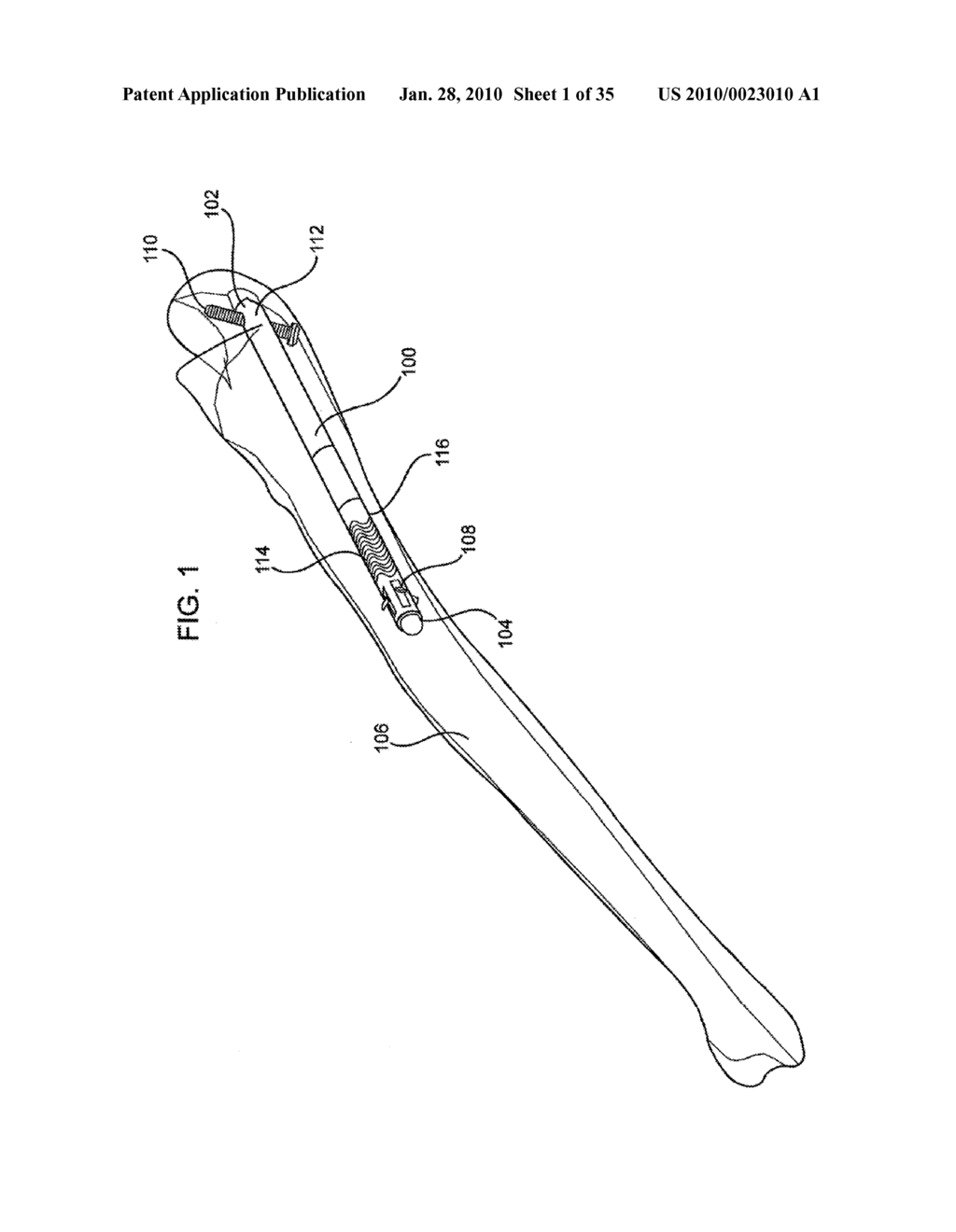 FRACTURE FIXATION DEVICE, TOOLS AND METHODS - diagram, schematic, and image 02