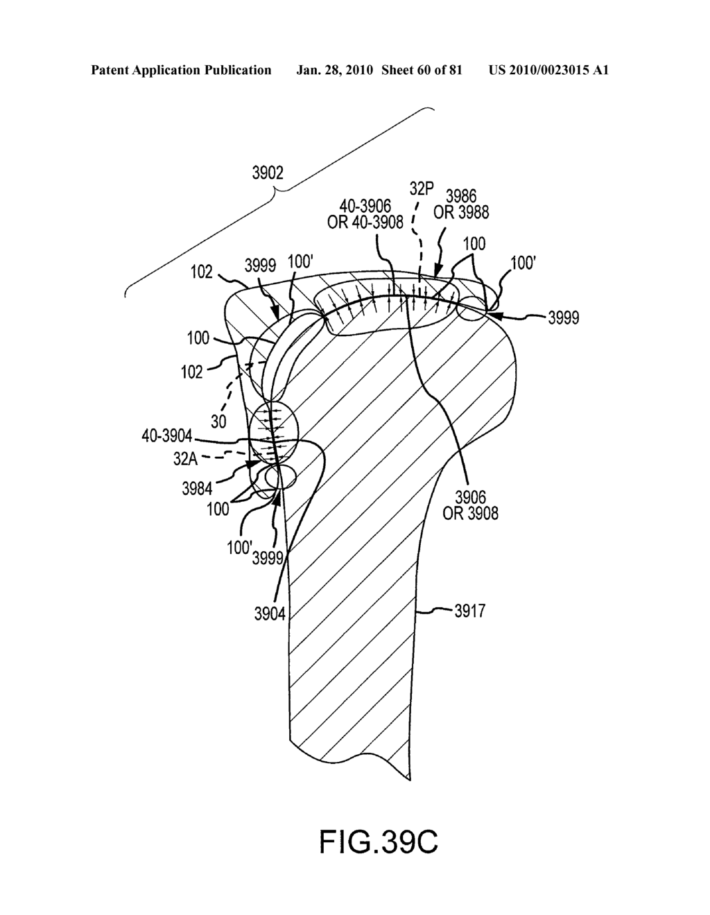 SYSTEM AND METHOD FOR MANUFACTURING ARTHROPLASTY JIGS HAVING IMPROVED MATING ACCURACY - diagram, schematic, and image 61