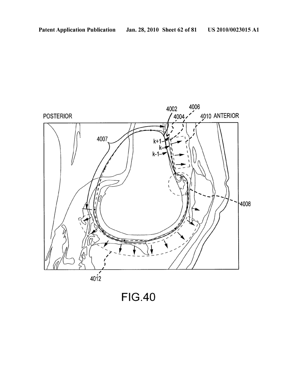 SYSTEM AND METHOD FOR MANUFACTURING ARTHROPLASTY JIGS HAVING IMPROVED MATING ACCURACY - diagram, schematic, and image 63