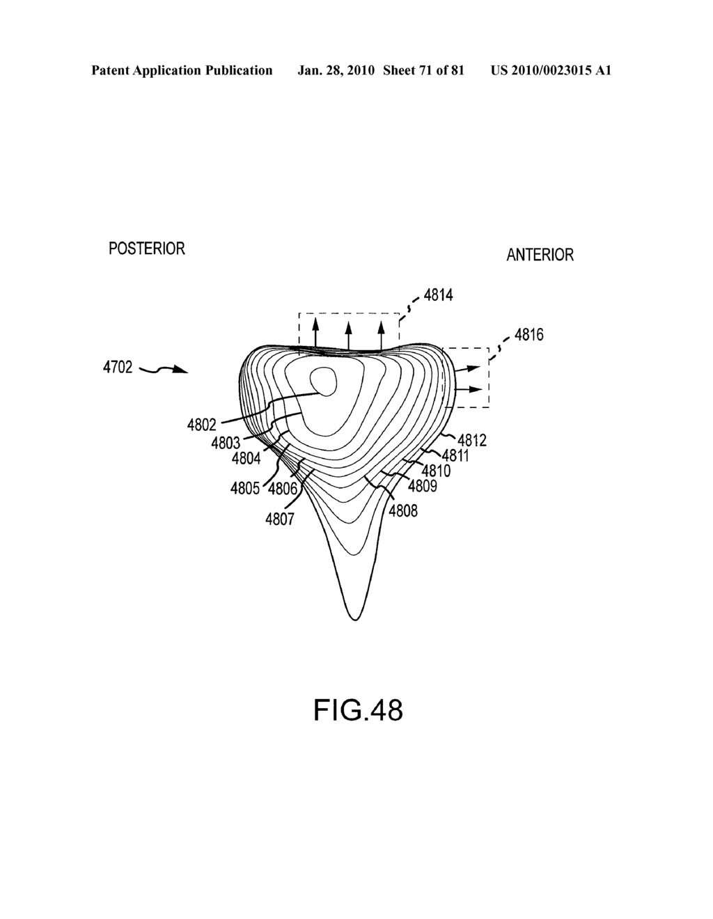 SYSTEM AND METHOD FOR MANUFACTURING ARTHROPLASTY JIGS HAVING IMPROVED MATING ACCURACY - diagram, schematic, and image 72