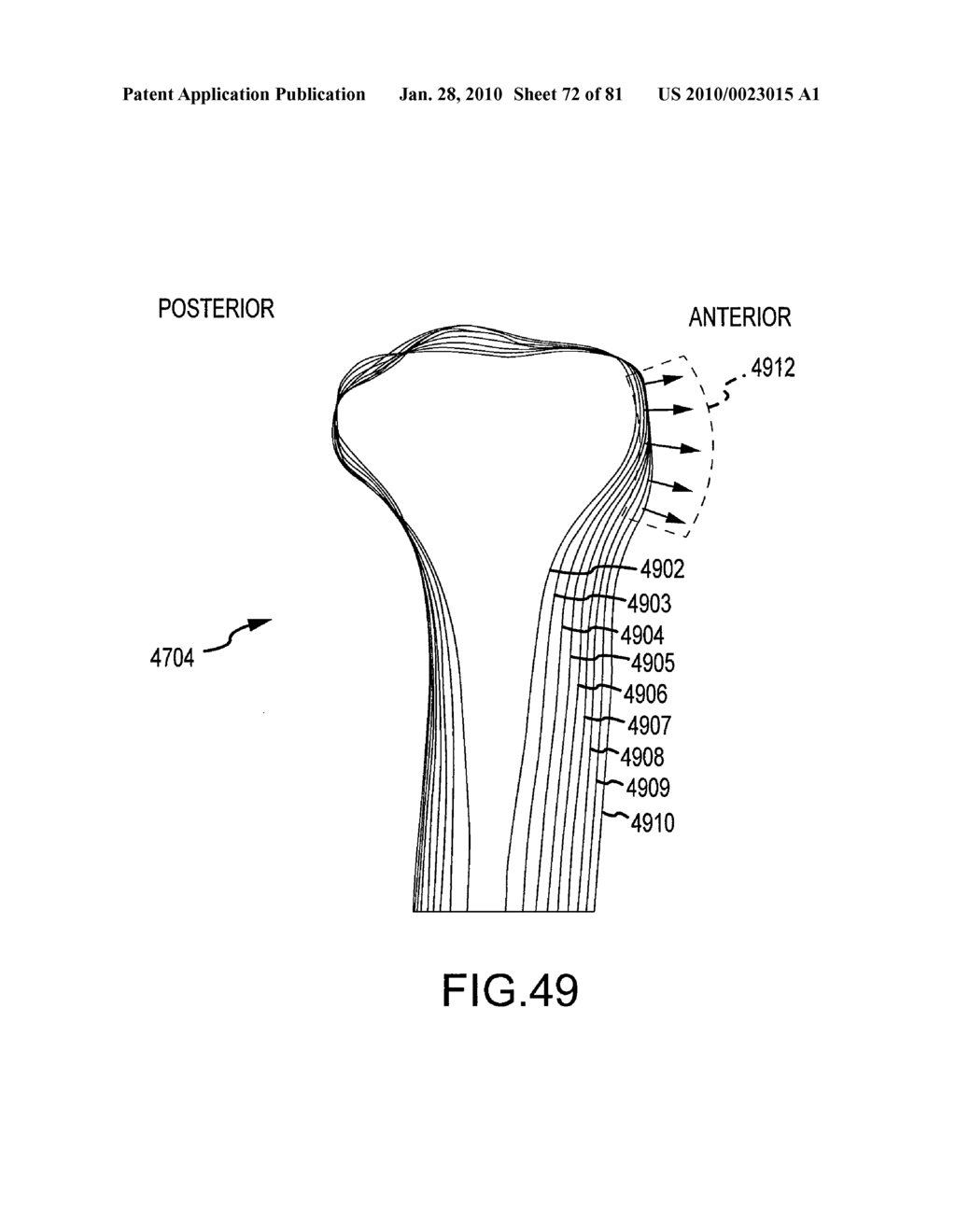 SYSTEM AND METHOD FOR MANUFACTURING ARTHROPLASTY JIGS HAVING IMPROVED MATING ACCURACY - diagram, schematic, and image 73