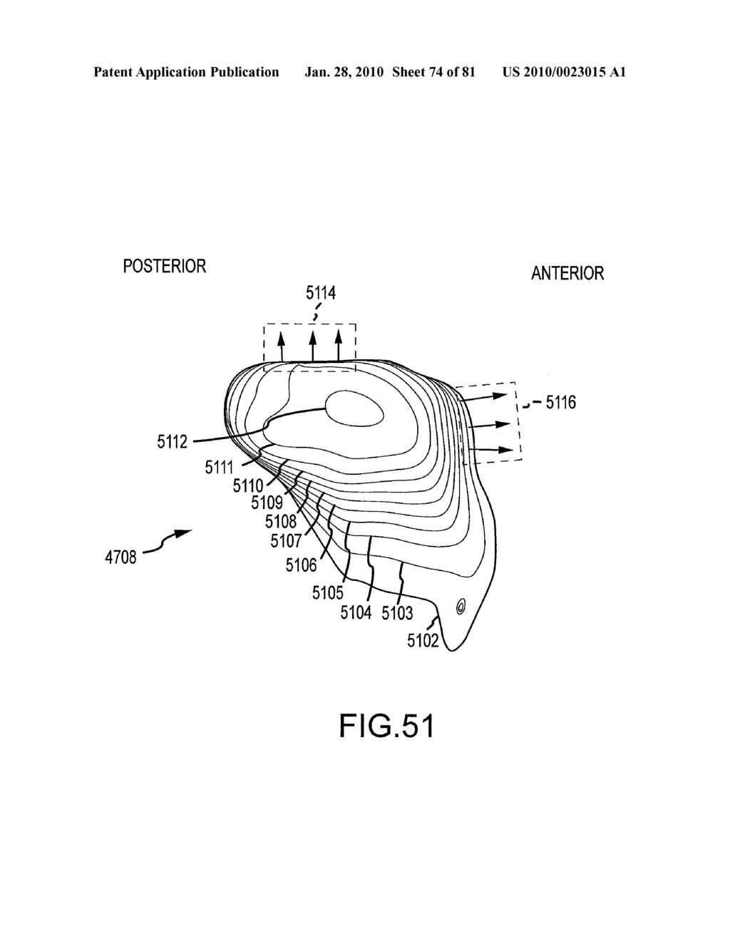 SYSTEM AND METHOD FOR MANUFACTURING ARTHROPLASTY JIGS HAVING IMPROVED MATING ACCURACY - diagram, schematic, and image 75