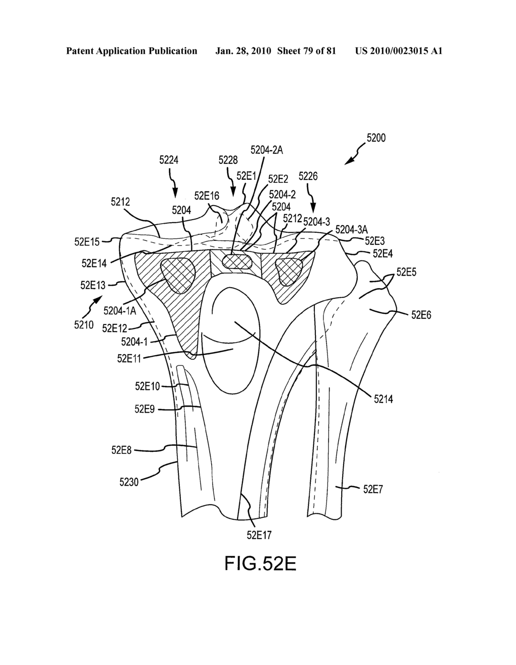 SYSTEM AND METHOD FOR MANUFACTURING ARTHROPLASTY JIGS HAVING IMPROVED MATING ACCURACY - diagram, schematic, and image 80