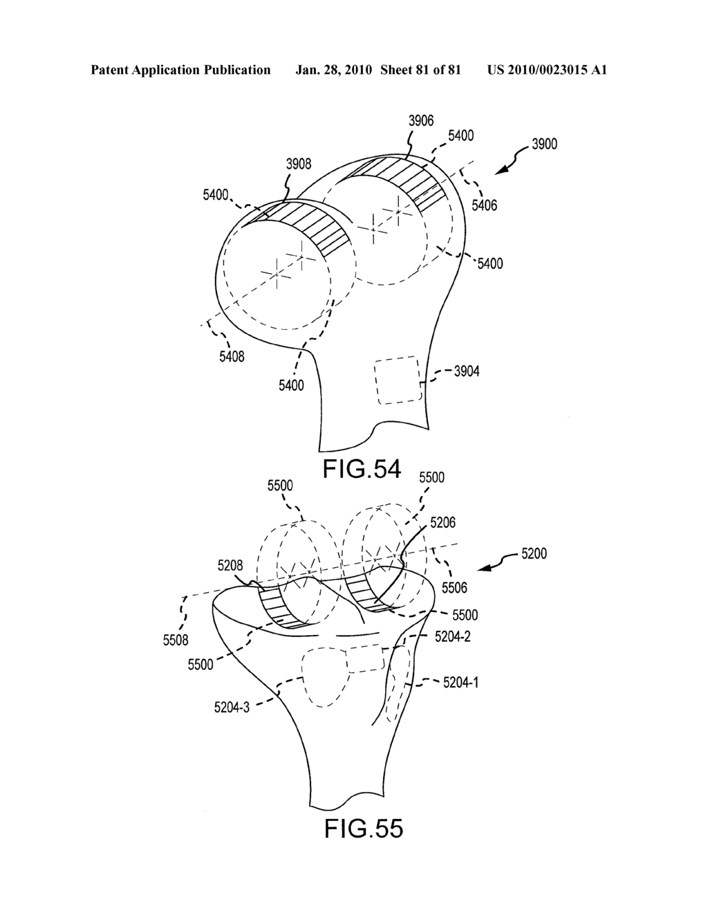 SYSTEM AND METHOD FOR MANUFACTURING ARTHROPLASTY JIGS HAVING IMPROVED MATING ACCURACY - diagram, schematic, and image 82