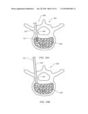 TISSUE ACCESS DEVICE WITH ALIGNMENT GUIDE AND METHODS OF USE diagram and image