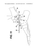 Method for Removal of Bone diagram and image