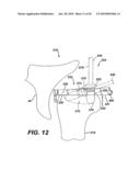 Method for Removal of Bone diagram and image