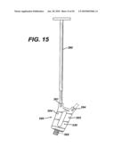 Method for Removal of Bone diagram and image