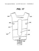 Method for Removal of Bone diagram and image