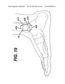 Method for Removal of Bone diagram and image