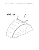 Method for Removal of Bone diagram and image