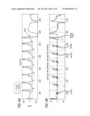 Methods for the Determination of T-Shock Vulnerable Window from Far-Field Electrograms in Implantable Cardioverter Defibrillators diagram and image