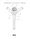 VASCULAR REMODELING DEVICE diagram and image