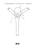 VASCULAR REMODELING DEVICE diagram and image