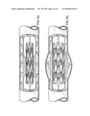 Multiple Drug Delivery From A Balloon And A Prosthesis diagram and image