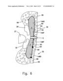 INTRAORAL CPAP INTERFACE diagram and image