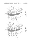 INTRAORAL CPAP INTERFACE diagram and image