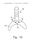 INTRAORAL CPAP INTERFACE diagram and image