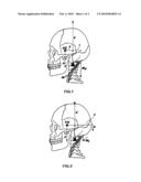 RELAXANT DEVICE OF MUSCLE FASCICLES IN THE CERVICAL DISTRICT diagram and image