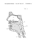 MAGNETIC IMPLANTS FOR TREATING OBSTRUCTIVE SLEEP APNEA AND METHODS THEREFOR diagram and image