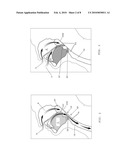 MAGNETIC IMPLANTS FOR TREATING OBSTRUCTIVE SLEEP APNEA AND METHODS THEREFOR diagram and image