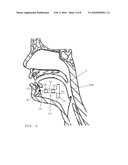 MAGNETIC IMPLANTS FOR TREATING OBSTRUCTIVE SLEEP APNEA AND METHODS THEREFOR diagram and image