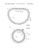 Intracardiac device for restoring the functional elasticity of the cardiac structures, holding tool for the intracardiac device, and method for implantation of the intracardiac device in the heart diagram and image