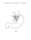 BARIATRIC DEVICE AND METHOD diagram and image