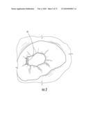 BARIATRIC DEVICE AND METHOD diagram and image