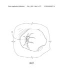 BARIATRIC DEVICE AND METHOD diagram and image