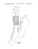 BARIATRIC DEVICE AND METHOD diagram and image