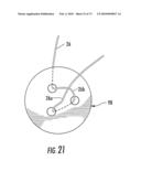 BARIATRIC DEVICE AND METHOD diagram and image