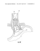 BARIATRIC DEVICE AND METHOD diagram and image