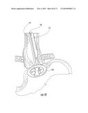 BARIATRIC DEVICE AND METHOD diagram and image