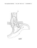 BARIATRIC DEVICE AND METHOD diagram and image