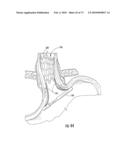 BARIATRIC DEVICE AND METHOD diagram and image