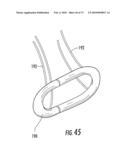 BARIATRIC DEVICE AND METHOD diagram and image