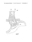 BARIATRIC DEVICE AND METHOD diagram and image