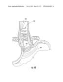 BARIATRIC DEVICE AND METHOD diagram and image