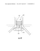 BARIATRIC DEVICE AND METHOD diagram and image