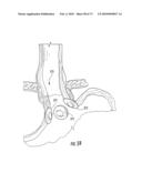 BARIATRIC DEVICE AND METHOD diagram and image