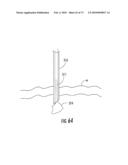 BARIATRIC DEVICE AND METHOD diagram and image