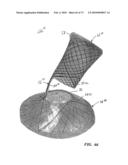 BARIATRIC DEVICE AND METHOD diagram and image