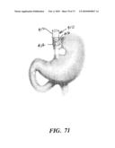 BARIATRIC DEVICE AND METHOD diagram and image