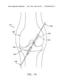 METHOD AND APPARATUS FOR FIXING A GRAFT IN A BONE TUNNEL diagram and image