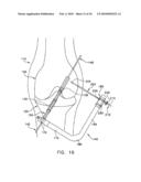 METHOD AND APPARATUS FOR FIXING A GRAFT IN A BONE TUNNEL diagram and image