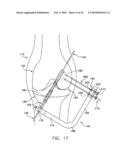 METHOD AND APPARATUS FOR FIXING A GRAFT IN A BONE TUNNEL diagram and image