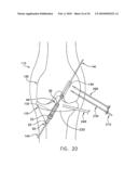 METHOD AND APPARATUS FOR FIXING A GRAFT IN A BONE TUNNEL diagram and image