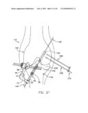 METHOD AND APPARATUS FOR FIXING A GRAFT IN A BONE TUNNEL diagram and image